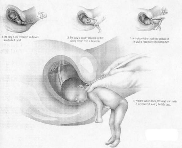 Late Term (Partial birth) Abortion